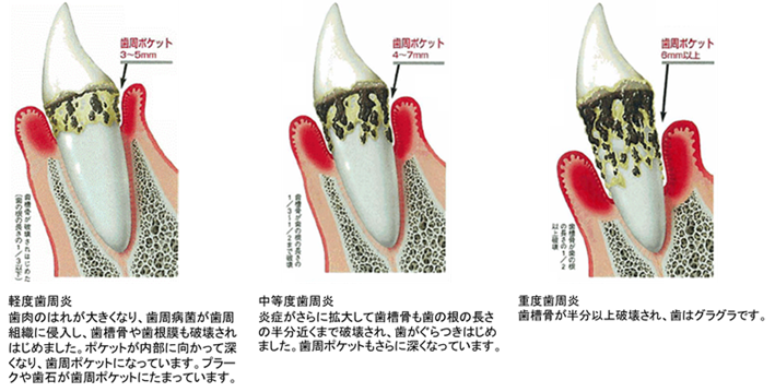 歯周炎