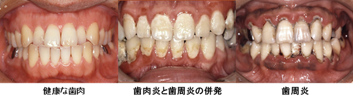 歯周炎の写真