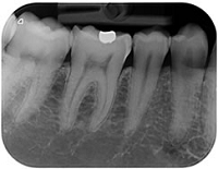 デンタルフィルム画像