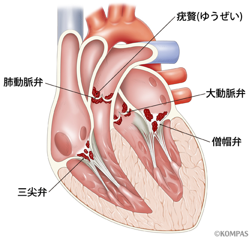 感染性心内膜炎
