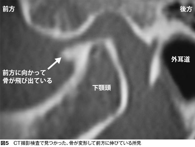 関節頭のCT画像